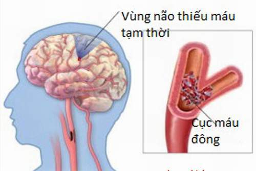 Nhầm Lẫn đột Quỵ Va đau Nửa đầu Nguy Hiểm