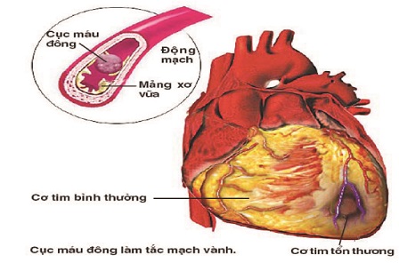 nhoi_mau_co_tim-1